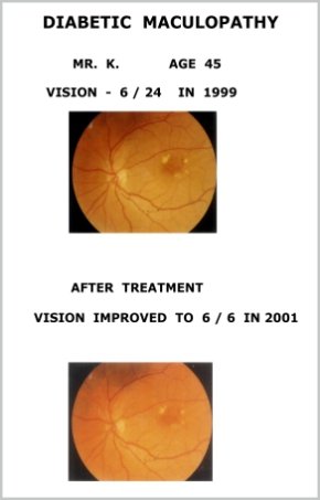 Diabetic Retinopathy